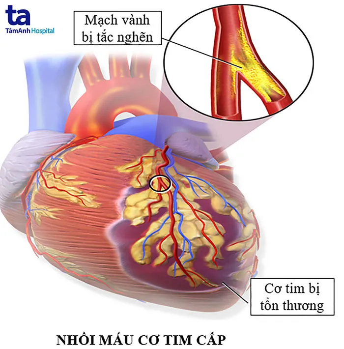 Infographic nhồi máu cơ tim