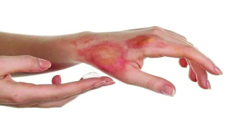 Quy trình sơ cứu bỏng dầu ăn cần thực hiện ngay lập tức