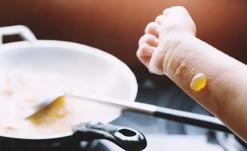 Những sai lầm nguy hiểm khi sơ cứu bỏng dầu ăn